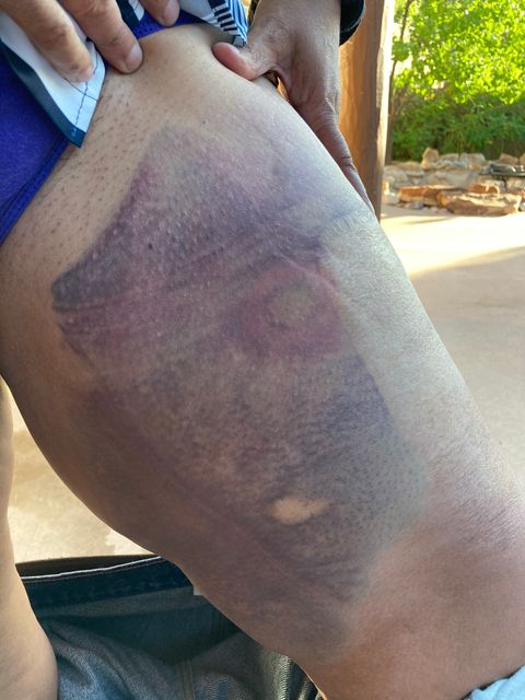 Bruise on the thigh of 'Selina Kyle' from a special impact munition. An officer fired on her at a distance of about five feet while her hands were up She said he smirked afterwards.